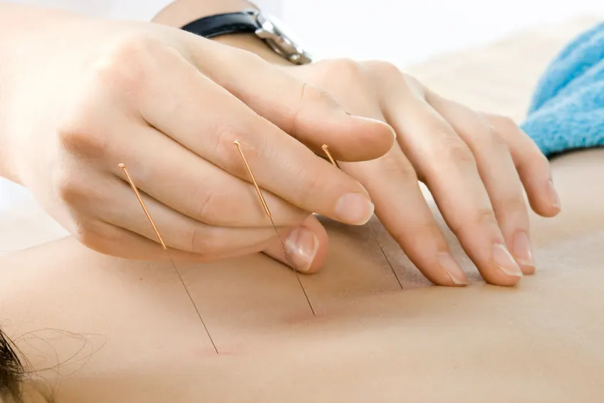Infertility And Acupuncture