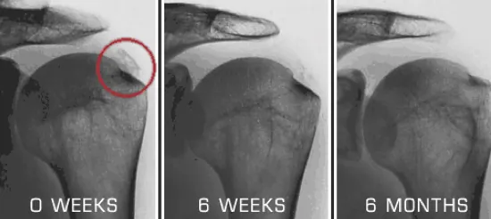 shockwave therapy calcific tendonitis
